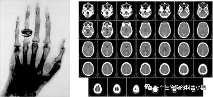 PET-CT：是个好技术，但别拿来搞癌症筛查！