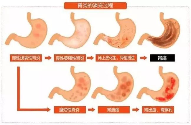 检查出肠上皮化生，是胃癌的前兆吗？