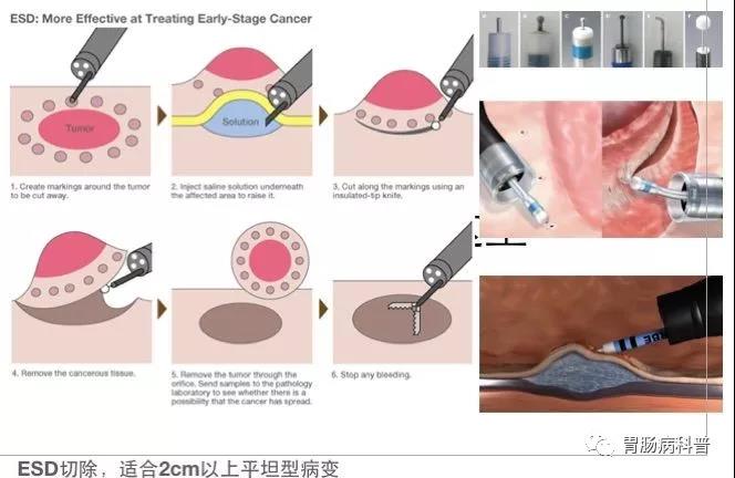 消化道癌（胃癌，食管癌，结直肠癌）早期不开刀——内镜粘膜下剥离术（ESD）