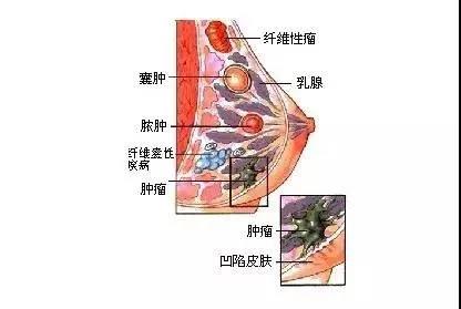 怀孕了！乳腺纤维腺瘤会趁机癌变吗？