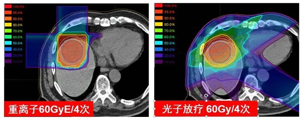 3年总生存率为72%,重离子治疗肝癌优势明显，上海市质子重离子医院