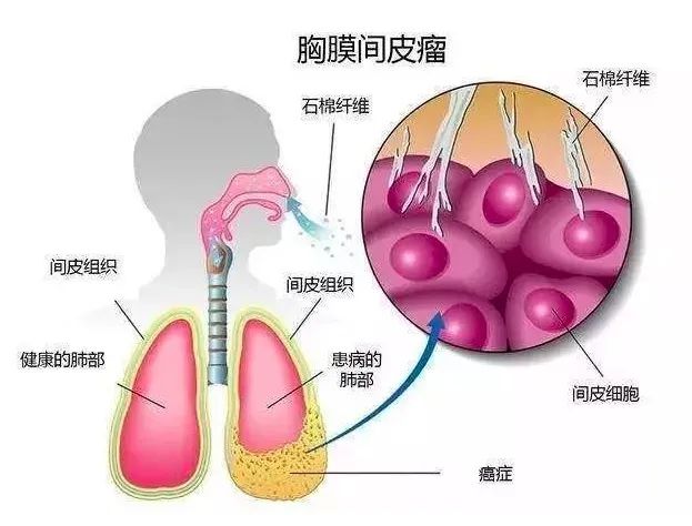 石棉致癌？高危人群如何筛查？