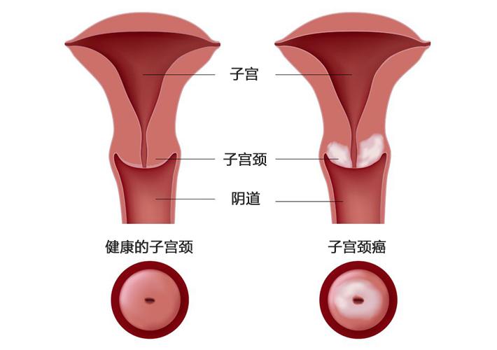 汪清：有了性生活，容易得宫颈癌吗？怎么筛查？