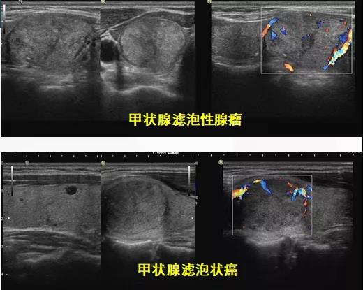 Lung Cancer pics