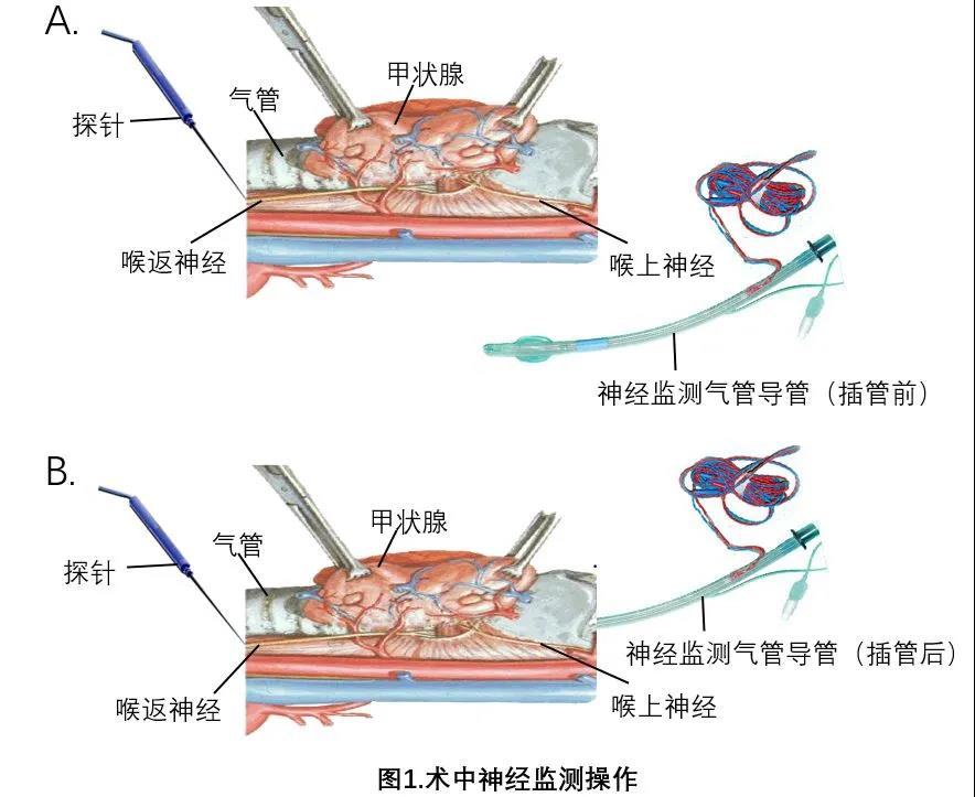 甲状腺手术并发症介绍：喉返/上神经损伤