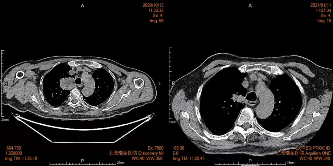 91岁的肺癌病人，癌细胞正在迅速消失