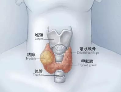 如何评估甲状腺结节的良恶性？