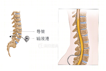 癌痛治疗的终极武器-中枢靶控镇痛系统植入术介绍