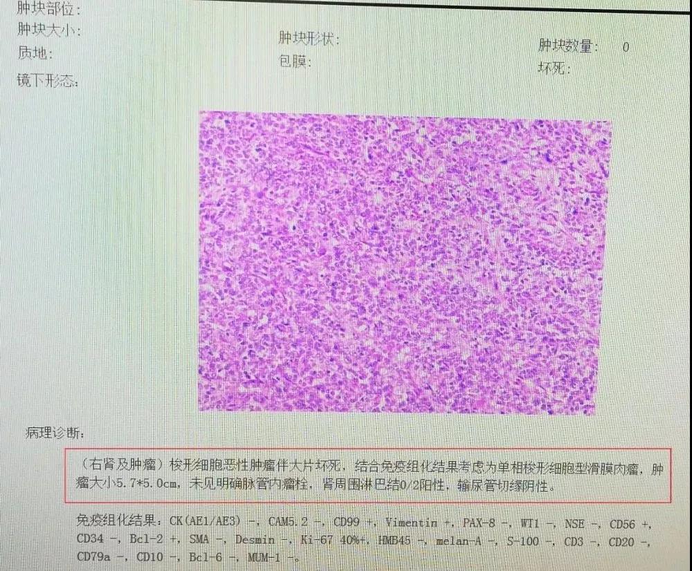 肾上多了“一泡水”肾囊肿，养了几年癌变了…