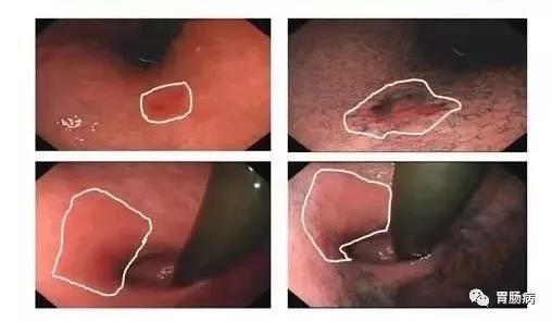 Lung Cancer pics