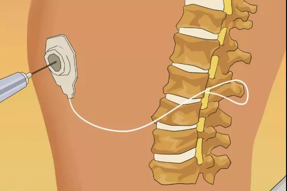 白天不能活动，晚上无法入睡......河南省肿瘤医院专家：治疗癌痛，需要