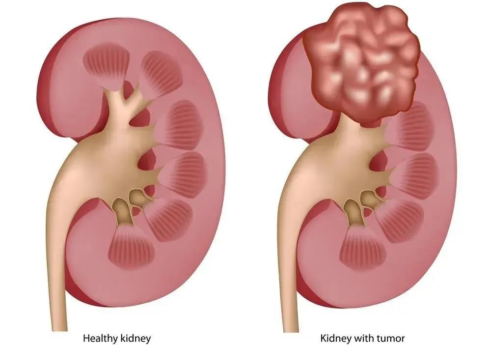 早期肾癌不痛不痒没感觉，怎么精确诊断呢？