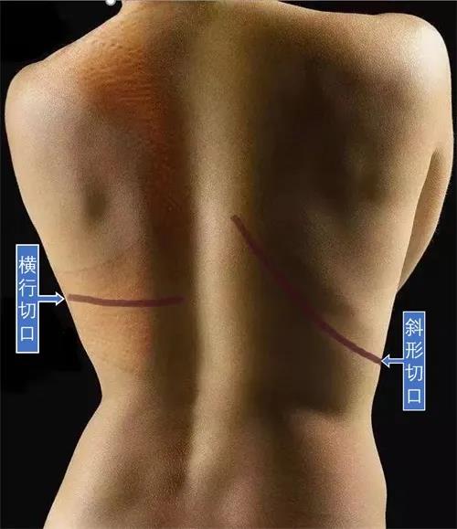 20岁女孩乳腺癌切除左乳，2年后“长”出来了，原来……