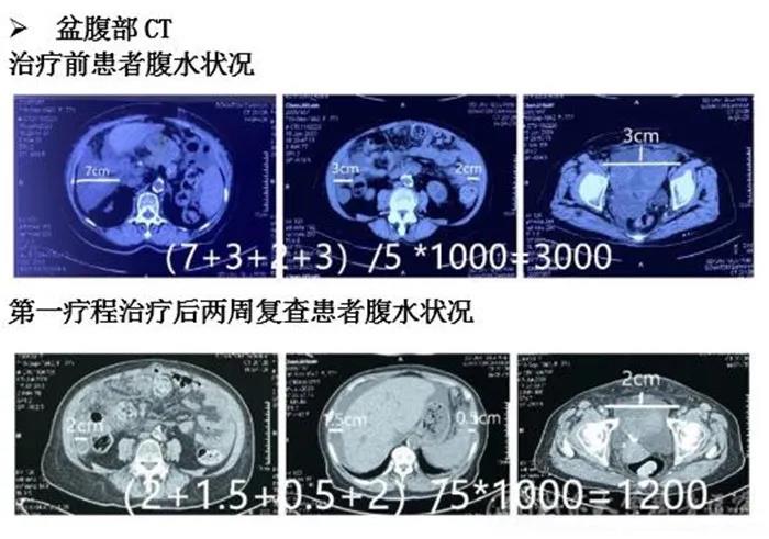 引入中国原研新技术，山东大学齐鲁医院妇产科完成载药囊泡治疗恶性