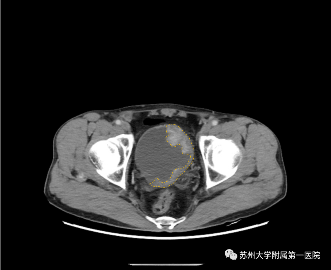 手术机器人助力，我院泌尿外科团队为膀胱癌患者重建新膀胱