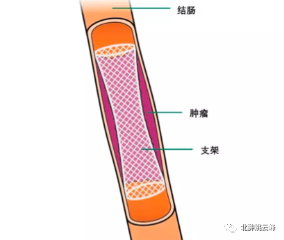 结直肠癌相关急腹症