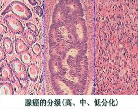 病理报告中的肿瘤细胞的分化是什么意思？