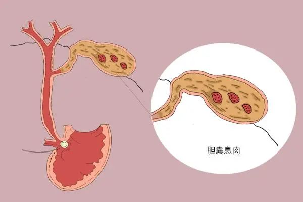 不吃早饭、爱喝奶茶、暴饮暴食，小心“胆”受伤！一文读懂胆囊疾病