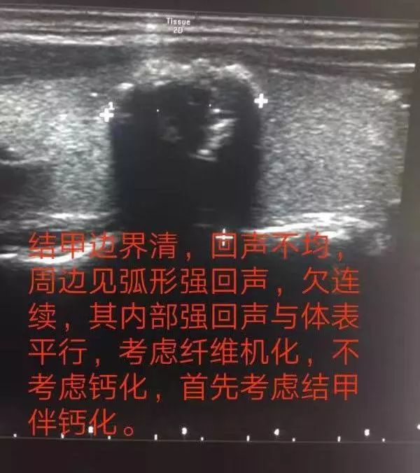 当“甲状腺结节”遇上“钙化”，就是癌？！