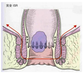 直肠癌患者看过来！福建医科大学附属第一医院极限保肛手术再突破，腹