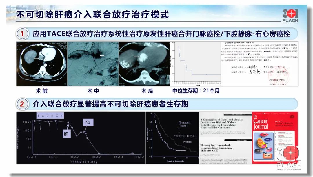 肝癌患者福音！多模态影像引导肝癌精确诊疗体系建立