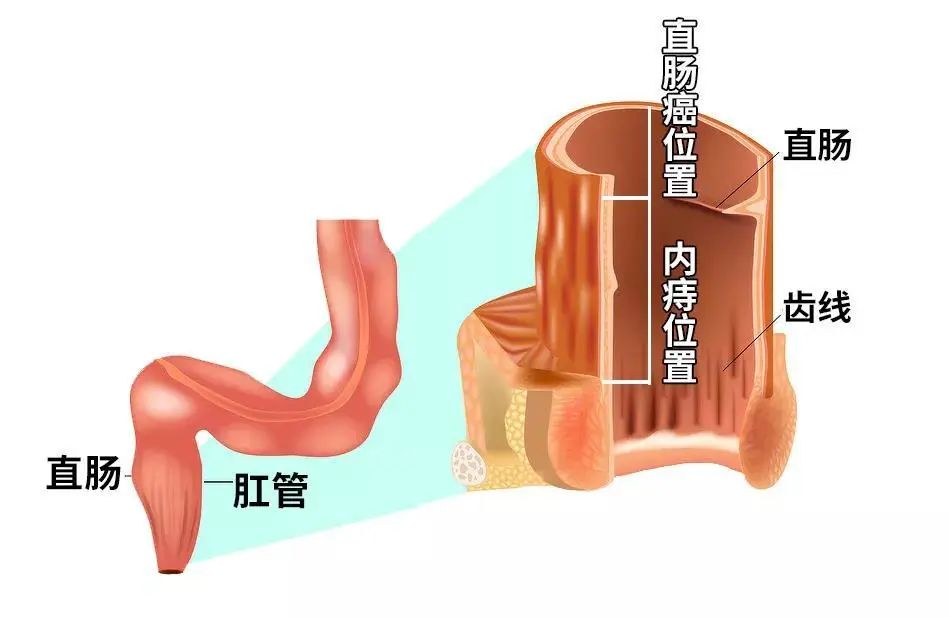 大便有血且符合这3个特点，不是痔疮犯了，可能是直肠癌