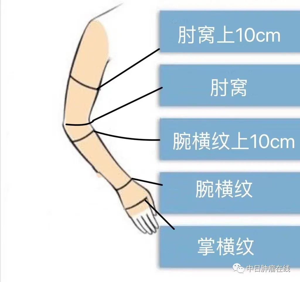 乳腺癌术后淋巴水肿知多少？