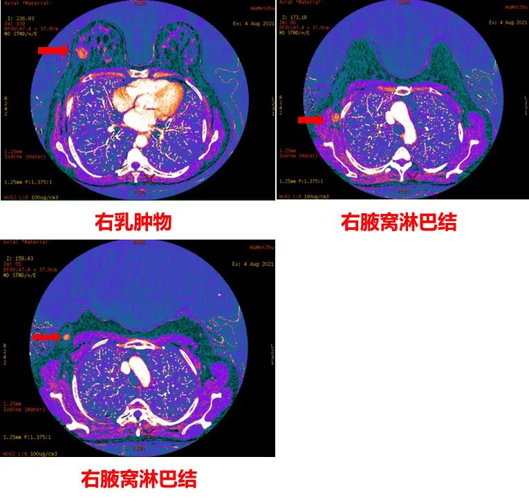 吡咯替尼新辅助HER2阳性乳腺癌