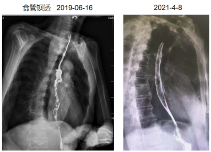 放疗联合卡瑞利珠单抗治疗老年局部晚期食管癌，为患者带来更好获益