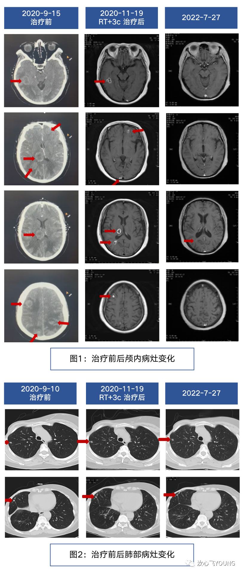 【病例分享】伊尼妥单抗联合吡咯替尼二线治疗曲妥珠单抗经治HER2