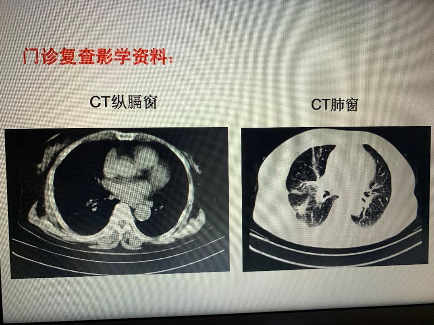 吉非替尼治疗晚期非小细胞肺癌患者一例