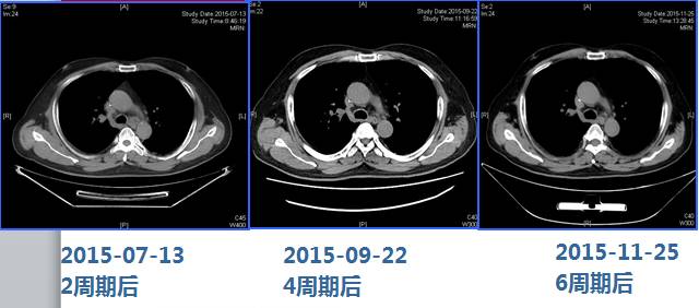 【病例分享】心怀感恩 共度新生——重组人血管内皮抑制素治疗肺