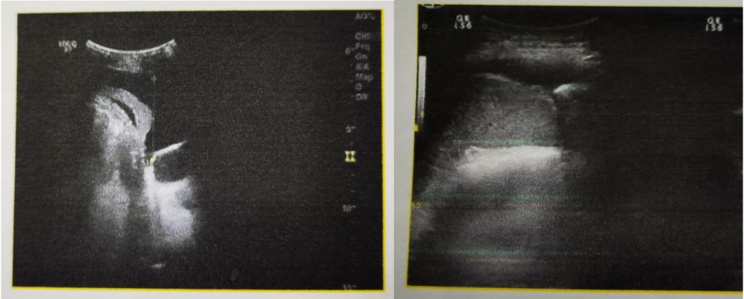 【恩度】有效改善恶性胸腔积液，提高肿瘤患者生活质量