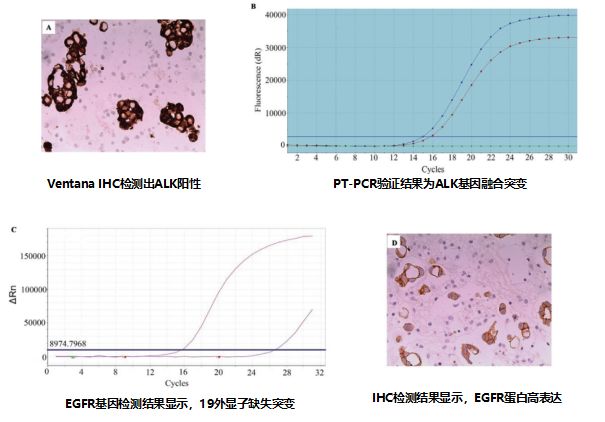 克唑替尼有效治疗ALK和EGFR双突变肺腺癌患者