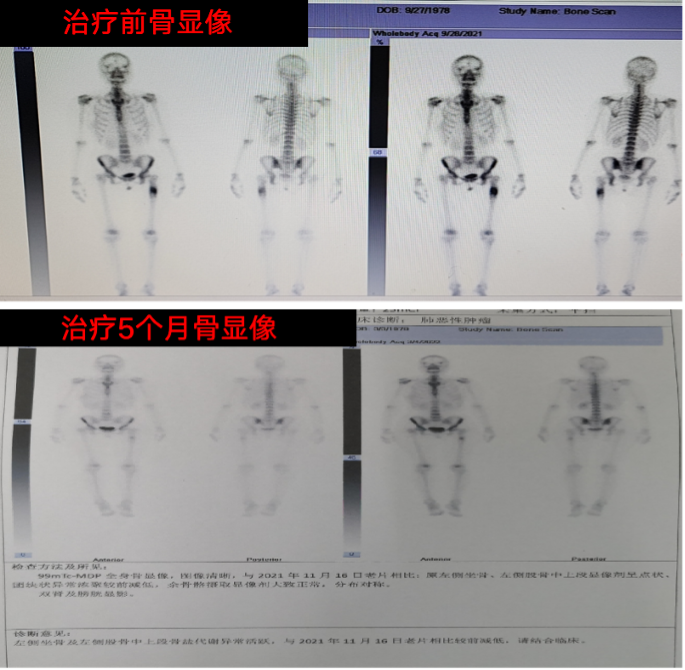 1例阿美替尼联合化疗一线治疗EGFR 19del突变非小细胞肺癌伴多发