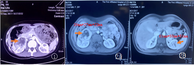 病例解析|培唑帕尼治疗显著改善VHL遗传性肾癌患者生存获益（患者PF