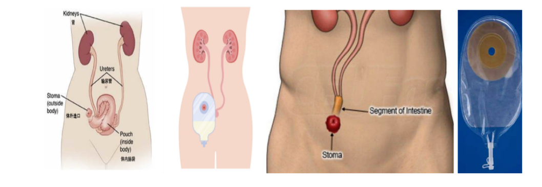 膀胱全切术后的常见尿流改道方式