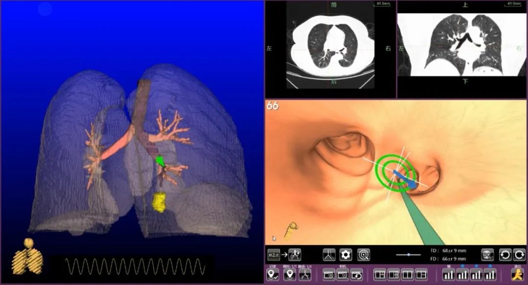 媒体聚焦 | “手术GPS”精准定位，将肺癌“狙击”在早期