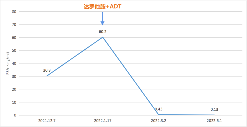 用药1月余PSA降幅高达99.3%，达罗他胺优效出击非转移阶段前列腺癌