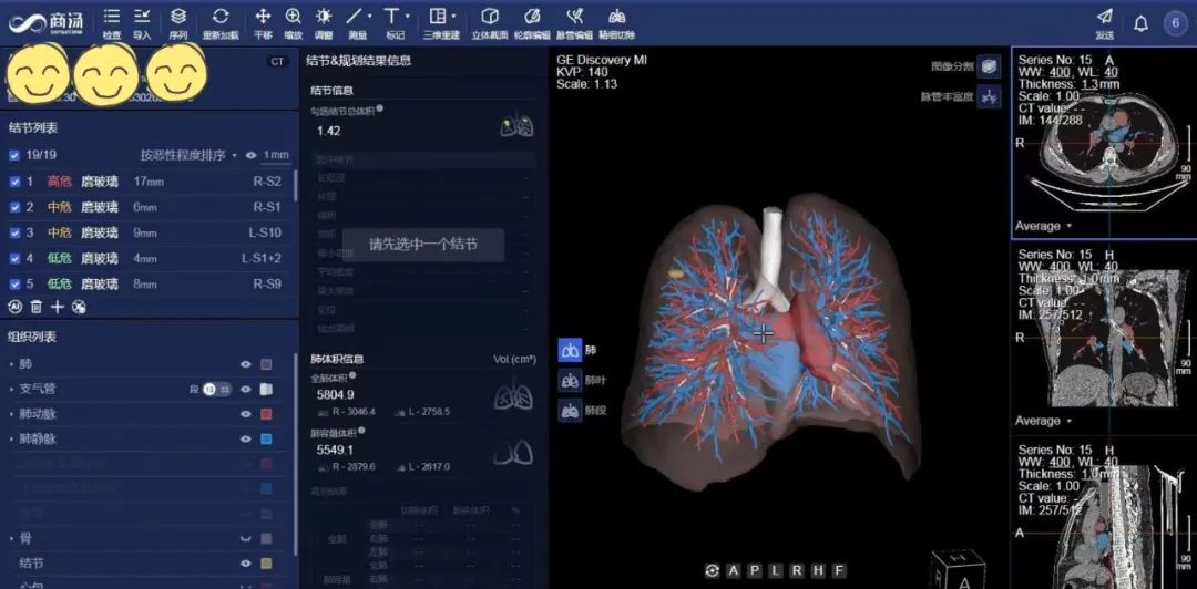 AI助手上线！瑞金胸外科创新诊疗让肺结节无处藏身