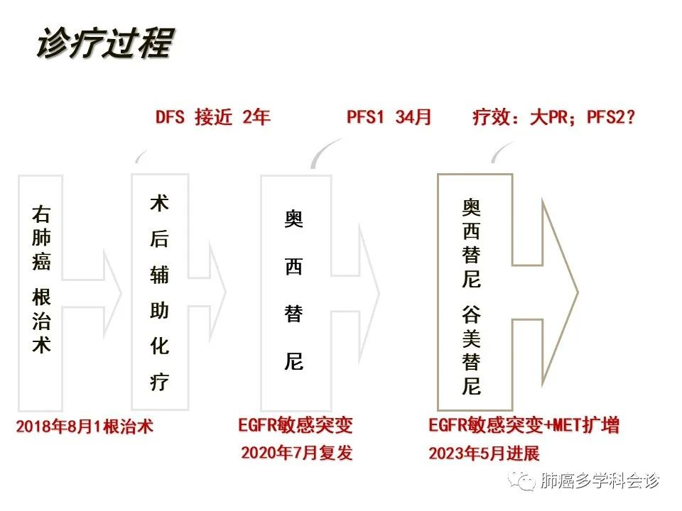 【病例分享】新型MET抑制剂“谷美替尼”在一例晚期EGFR+肺腺癌TK