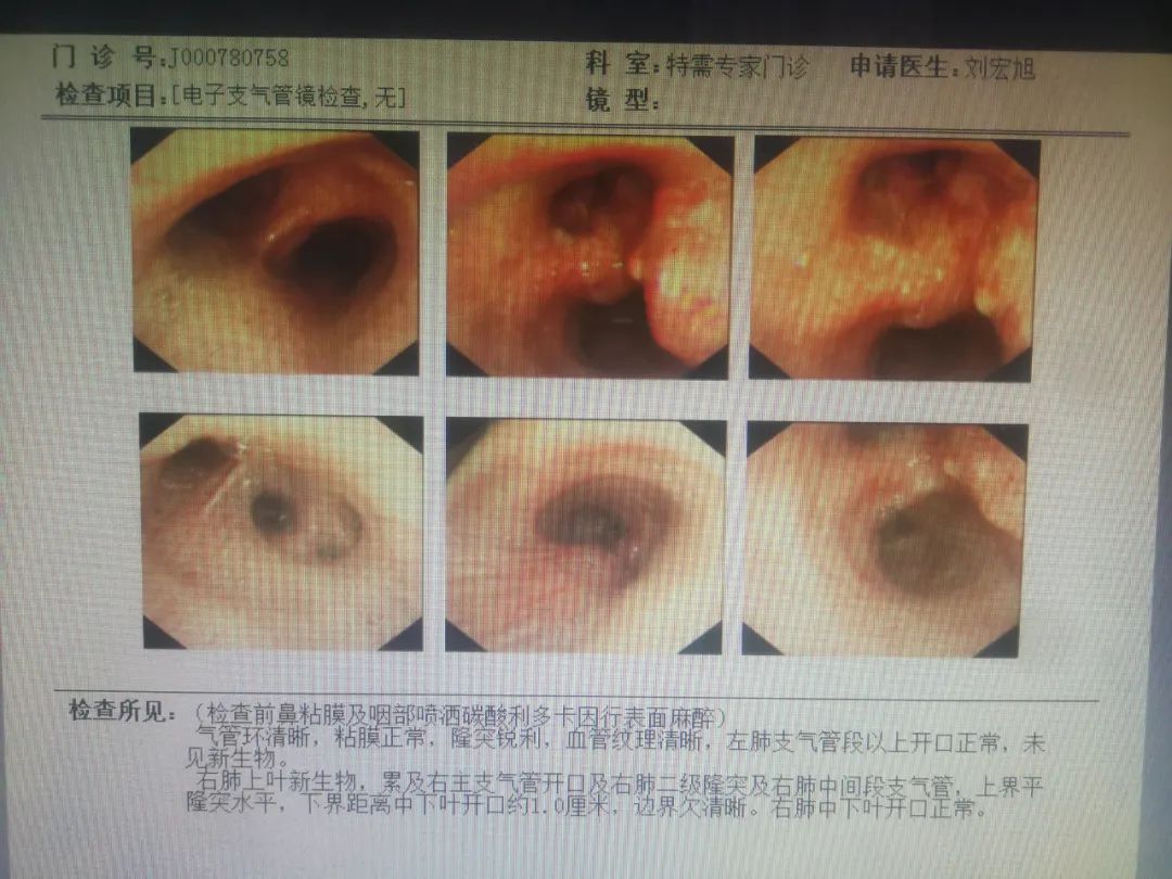 辽宁省肿瘤医院胸外科团队联合麻醉和手术室团队成功开展非气管插