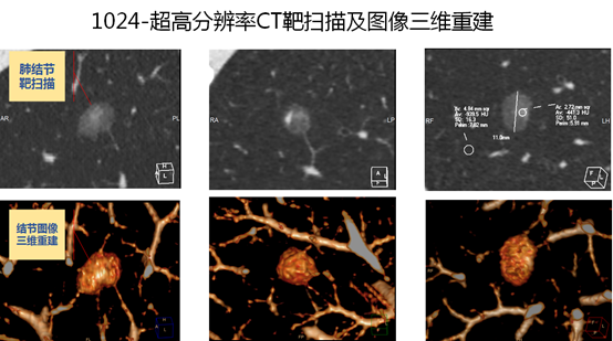 肺结节=肺癌？莫让“结节”变“心结”，让新华专家来鉴别！