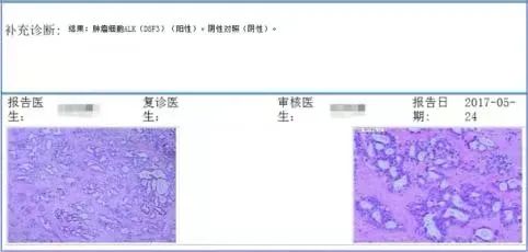 ALK阳性肺癌脑转移2代药耐药后出现ALK扩增，还用2代吗？