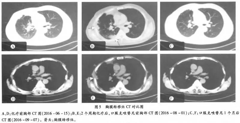 c-MET扩增阳性伴胸膜转移的肺腺癌患者可以从克唑替尼治疗中获益