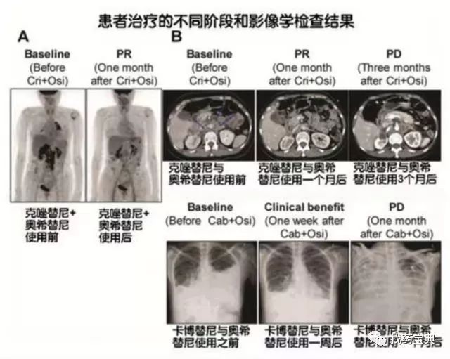 奥希耐药，MET使劲，突变再突变，沃利序贯克唑替尼，克唑序贯卡博！