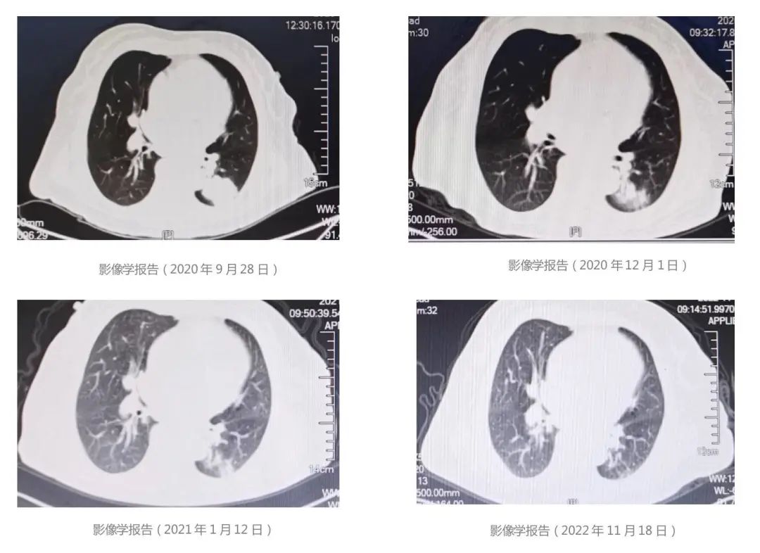 肺腑之言│METex14跳跃突变晚期NSCLC，特泊替尼助力持久缓解