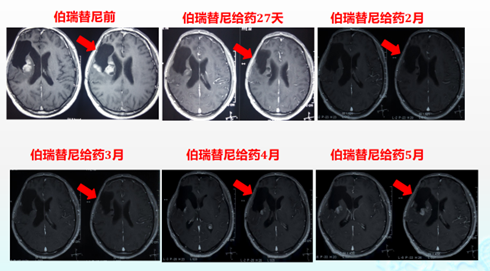 遇见未来 | 脑胶质瘤靶向治疗任重道远，MET抑制剂伯瑞替尼有望取得新突破