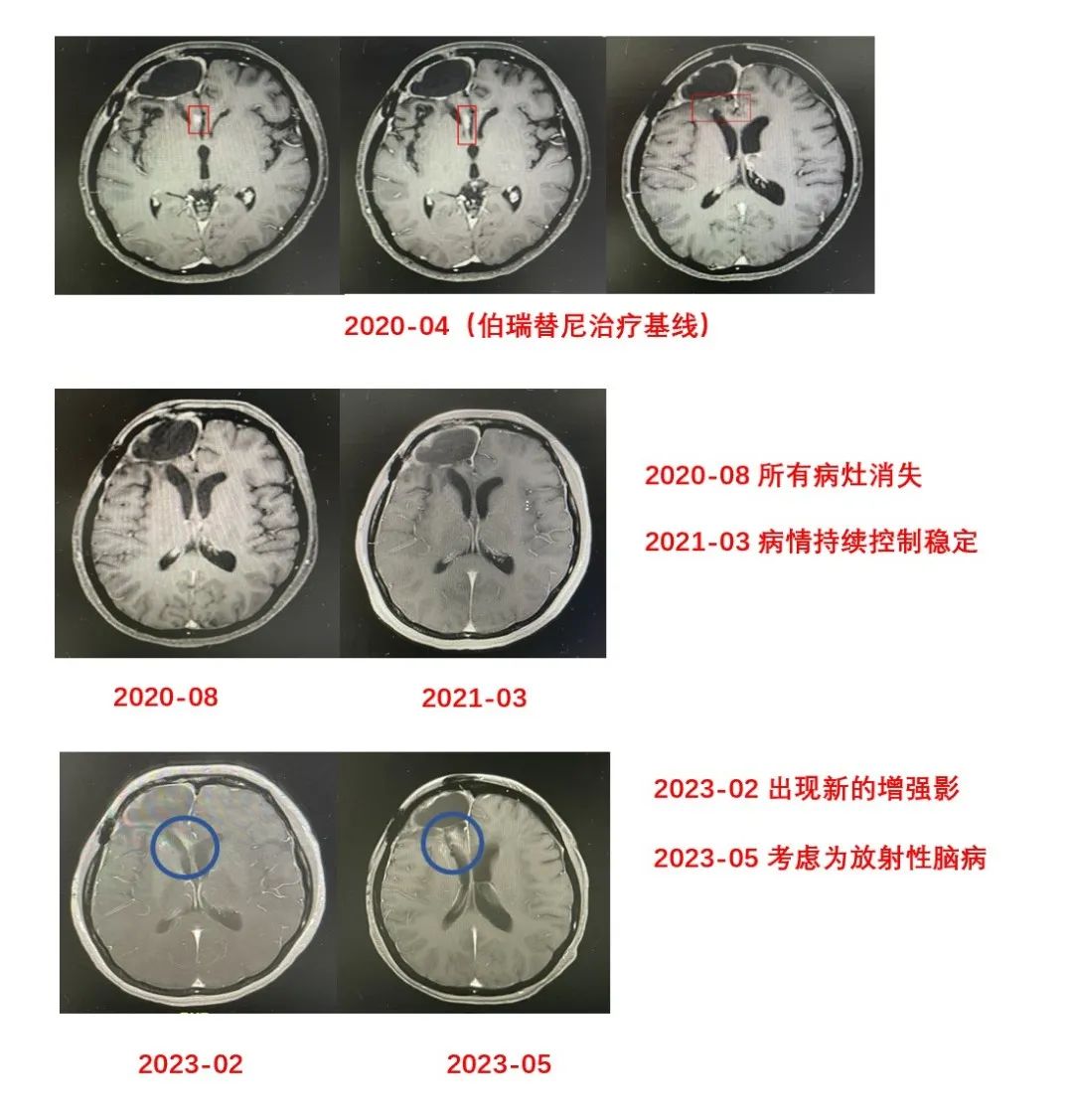 遇见未来|MET抑制剂伯瑞替尼为MET异常脑胶质瘤患者带来新希望