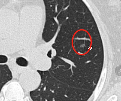 观察了六年的肺结节，一根小血管把它出卖了